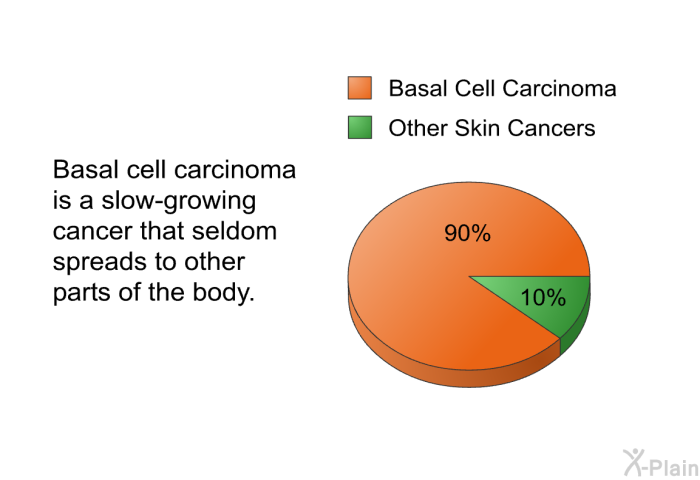 Basal cell carcinoma is a slow-growing cancer that seldom spreads to other parts of the body.