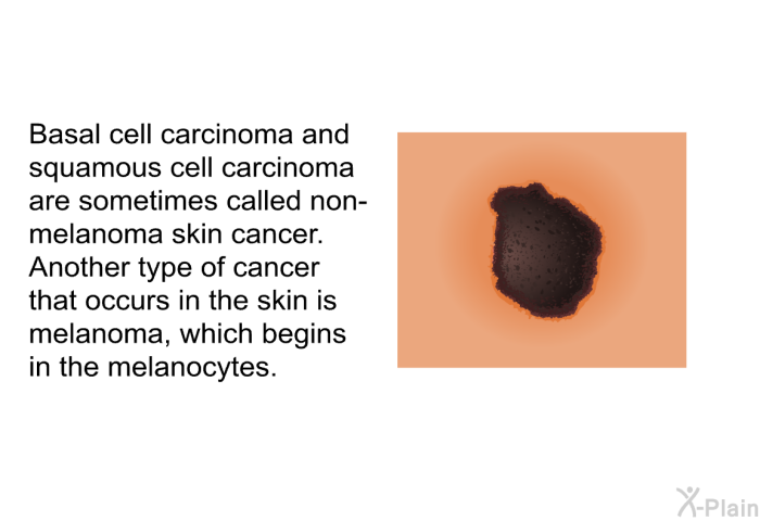 Basal cell carcinoma and squamous cell carcinoma are sometimes called <I>non-melanoma</I> skin cancer. Another type of cancer that occurs in the skin is melanoma, which begins in the melanocytes.
