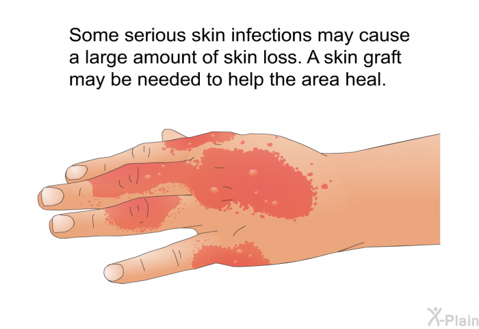 Some serious skin infections may cause a large amount of skin loss. A skin graft may be needed to help the area heal.