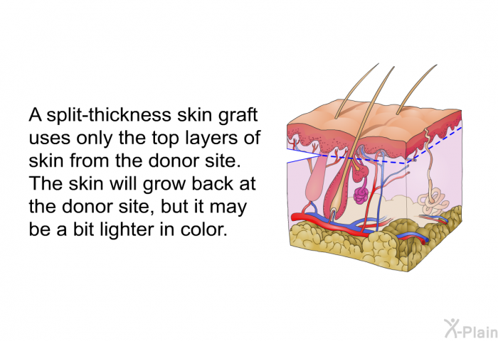 A split-thickness skin graft uses only the top layers of skin from the donor site. The skin will grow back at the donor site, but it may be a bit lighter in color.