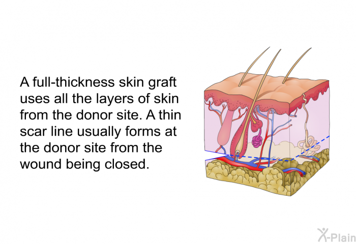 A full-thickness skin graft uses all the layers of skin from the donor site. A thin scar line usually forms at the donor site from the wound being closed.