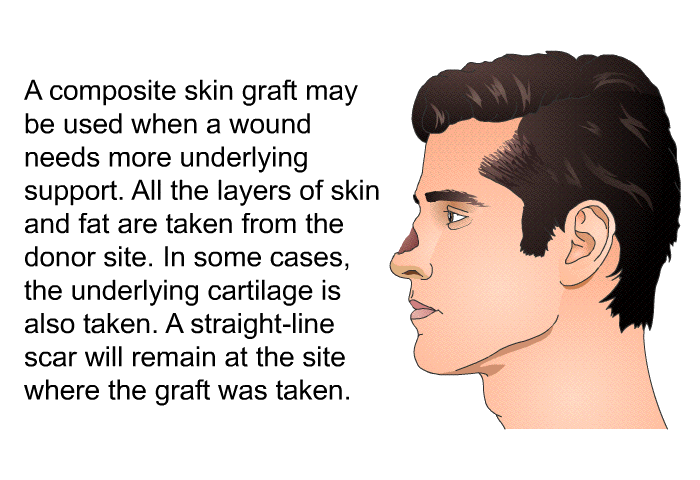 A composite skin graft may be used when a wound needs more underlying support. All the layers of skin and fat are taken from the donor site. In some cases, the underlying cartilage is also taken. A straight-line scar will remain at the site where the graft was taken.