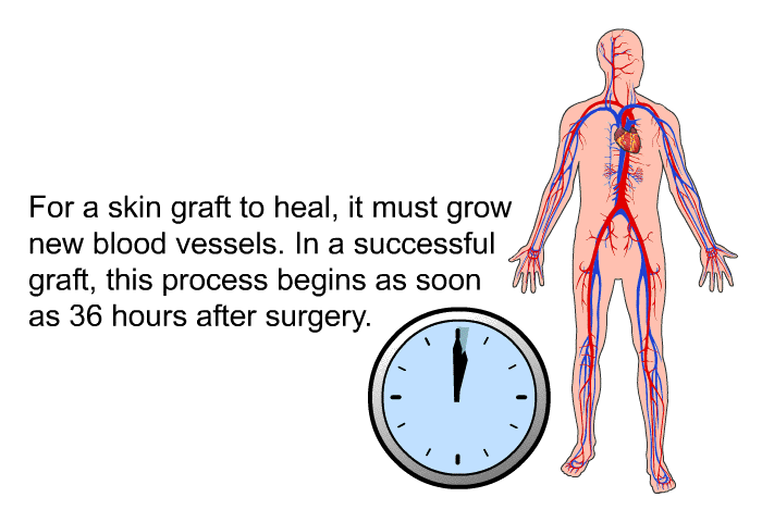 For a skin graft to heal, it must grow new blood vessels. In a successful graft, this process begins as soon as 36 hours after surgery.