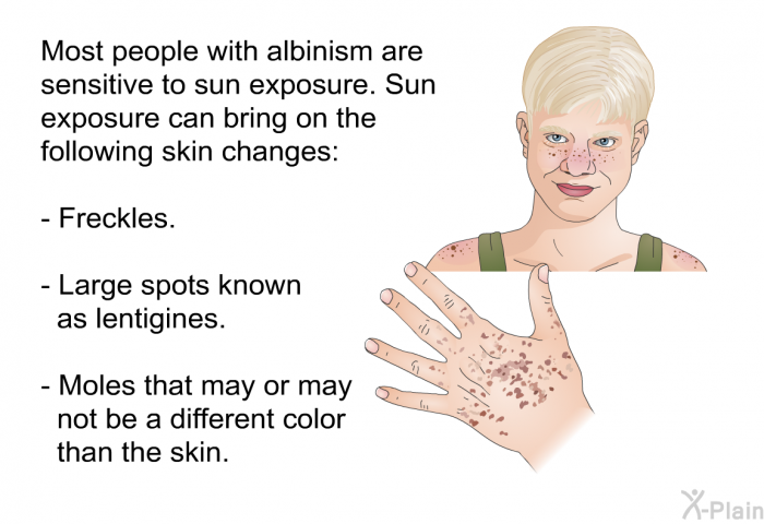 Most people with albinism are sensitive to sun exposure. Sun exposure can bring on the following skin changes:  Freckles. Large spots known as lentigines. Moles that may or may not be a different color than the skin.