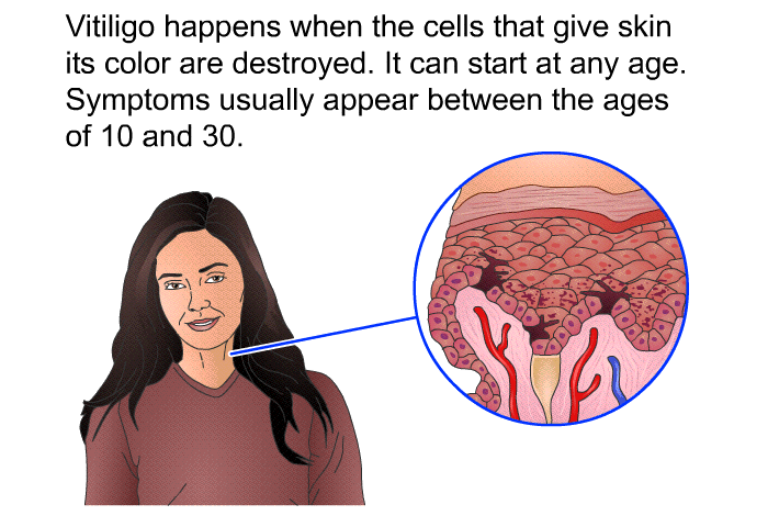Vitiligo happens when the cells that give skin its color are destroyed. It can start at any age. Symptoms usually appear between the ages of 10 and 30.