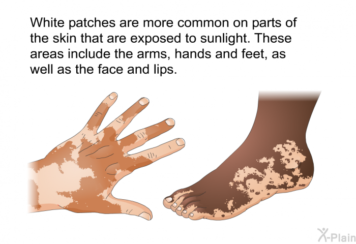 White patches are more common on parts of the skin that are exposed to sunlight. These areas include the arms, hands and feet, as well as the face and lips.