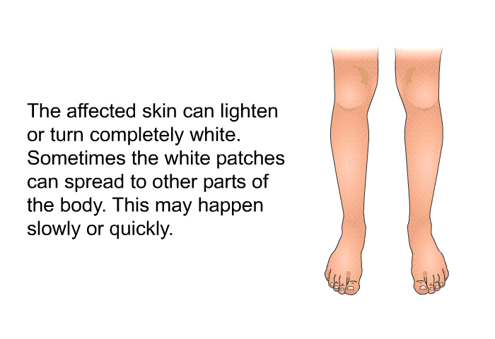 The affected skin can lighten or turn completely white. Sometimes the white patches can spread to other parts of the body. This may happen slowly or quickly.