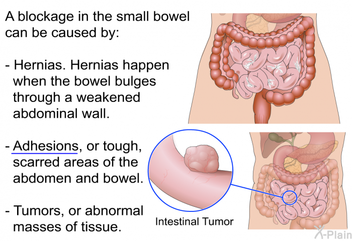 A blockage in the small bowel can be caused by:  Hernias. Hernias happen when the bowel bulges through a weakened abdominal wall. Adhesions, or tough, scarred areas of the abdomen and bowel. Tumors, or abnormal masses of tissue.