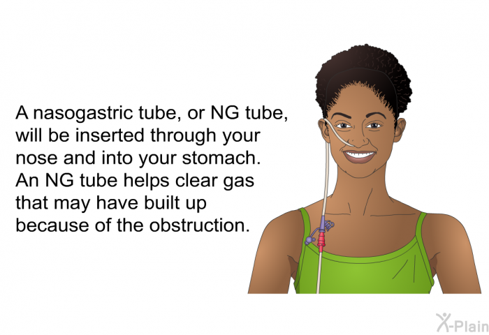 A nasogastric tube, or NG tube, will be inserted through your nose and into your stomach. An NG tube helps clear gas that may have built up because of the obstruction.