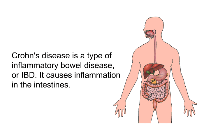 Crohn's disease is a type of inflammatory bowel disease, or IBD. It causes inflammation in the intestines.