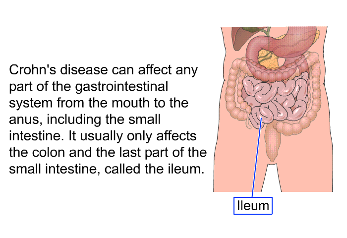 Crohn's disease can affect any part of the gastrointestinal system from the mouth to the anus, including the small intestine. It usually only affects the colon and the last part of the small intestine, called the ileum.