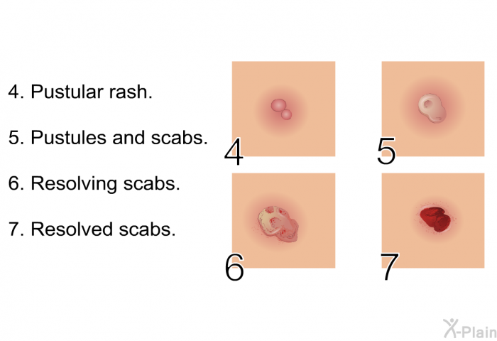 Pustular rash. Pustules and scabs. Resolving scabs. Resolved scabs.