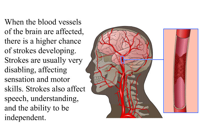 When the blood vessels of the brain are affected, there is a higher chance of strokes developing. Strokes are usually very disabling, affecting sensation and motor skills. Strokes also affect speech, understanding, and the ability to be independent.