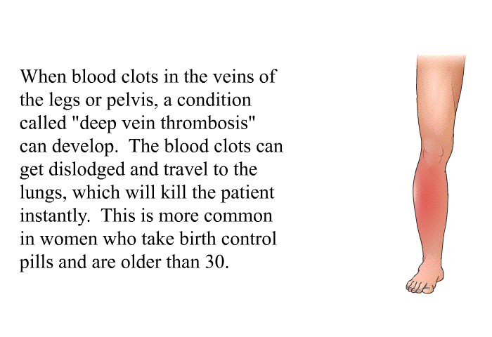 When blood clots in the veins of the legs or pelvis, a condition called “deep vein thrombosis” can develop. The blood clots can get dislodged and travel to the lungs, which will kill the patient instantly. This is more common in women who take birth control pills and are older than 30.