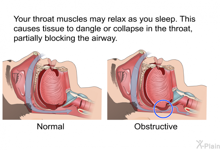 Your throat muscles may relax as you sleep. This causes tissue to dangle or collapse in the throat, partially blocking the airway.