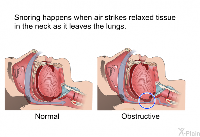 Snoring happens when air strikes relaxed tissue in the neck as it leaves the lungs.