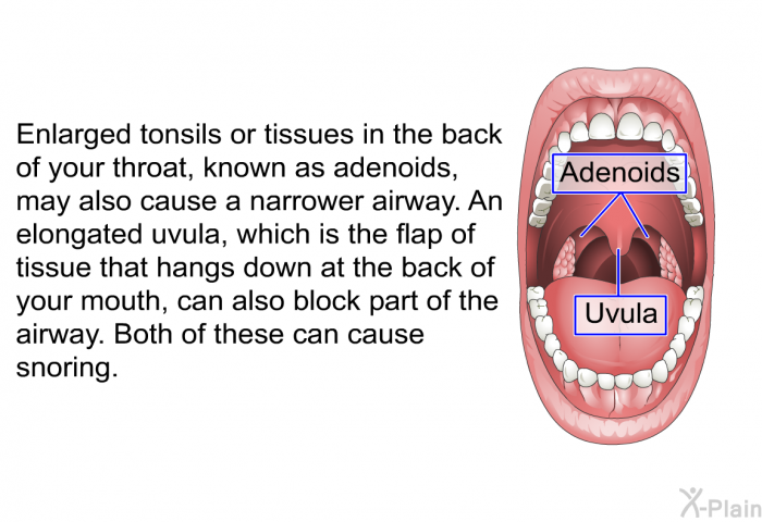 Enlarged tonsils or tissues in the back of your throat, known as adenoids, may also cause a narrower airway. An elongated uvula, which is the flap of tissue that hangs down at the back of your mouth, can also block part of the airway. Both of these can cause snoring.