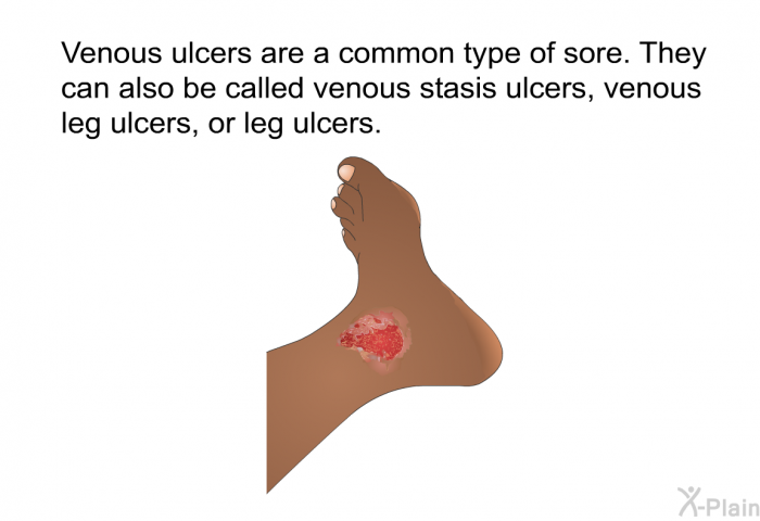 Venous ulcers are a common type of sore. They can also be called venous stasis ulcers, venous leg ulcers, or leg ulcers.