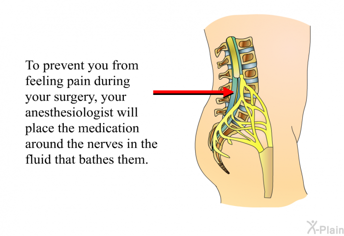 To prevent you from feeling pain during your surgery, your anesthesiologist will place the medication around the nerves in the fluid that bathes them.