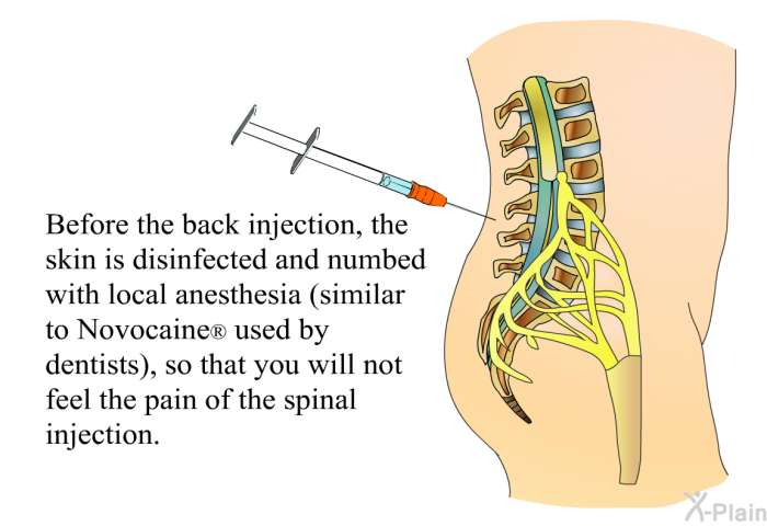 Before the back injection, the skin is disinfected and numbed with local anesthesia (similar to Novocaine  used by dentists), so that you will not feel the pain of the spinal injection.