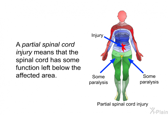 A <I>partial spinal cord injury</I> means that the spinal cord has some function left below the affected area.