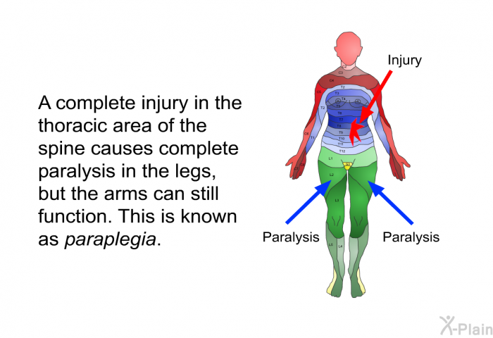 A complete injury in the thoracic area of the spine causes complete paralysis in the legs, but the arms can still function. This is known as paraplegia.