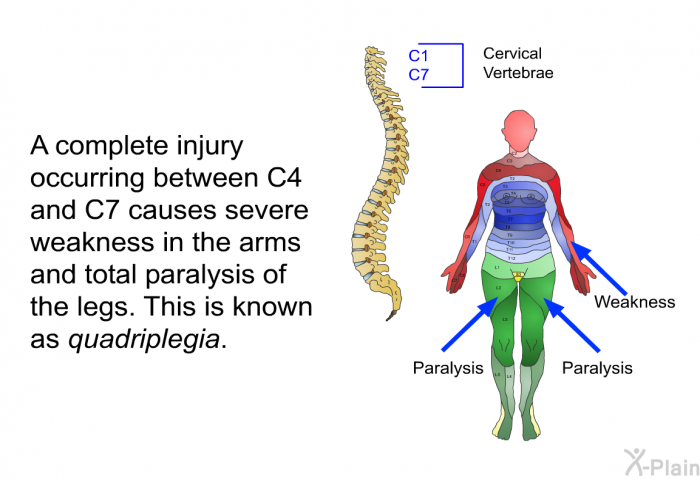 A complete injury occurring between C4 and C7 causes severe weakness in the arms and total paralysis of the legs. This is known as quadriplegia.