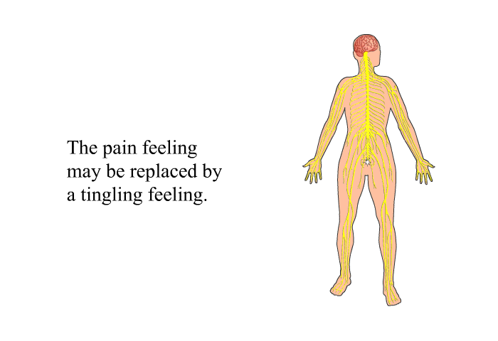 The pain feeling may be replaced by a tingling feeling.