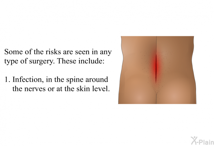 Some of the risks are seen in any type of surgery. These include:  Infection, in the spine around the nerves or at the skin level.
