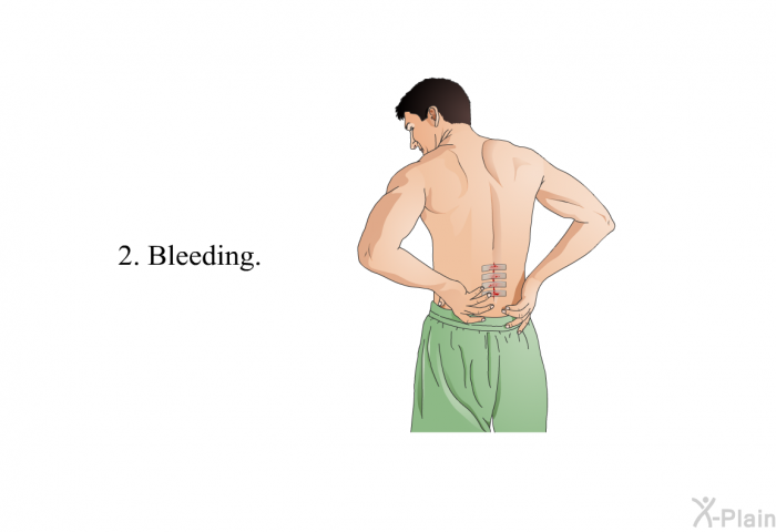 Bleeding.