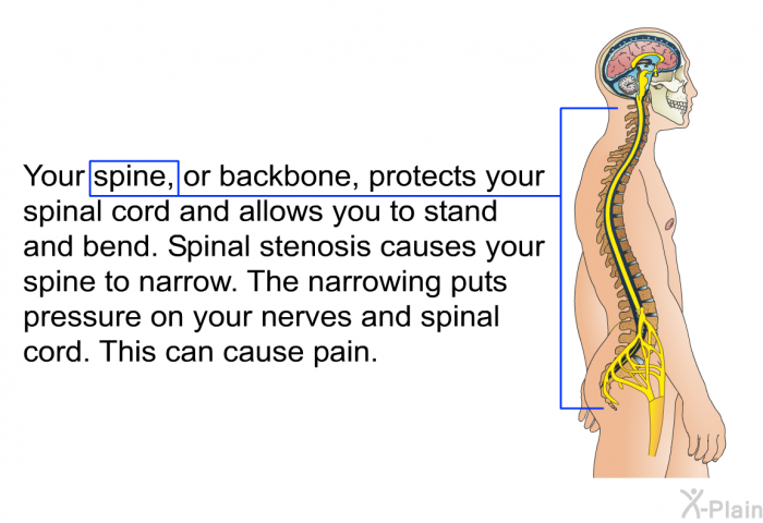 Your spine, or backbone, protects your spinal cord and allows you to stand and bend. Spinal stenosis causes your spine to narrow. The narrowing puts pressure on your nerves and spinal cord. This can cause pain.