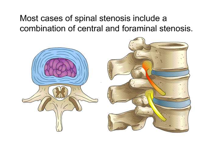 Most cases of spinal stenosis include a combination of central and foraminal stenosis.