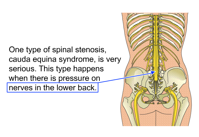 One type of spinal stenosis, cauda equina syndrome, is very serious. This type happens when there is pressure on nerves in the lower back.