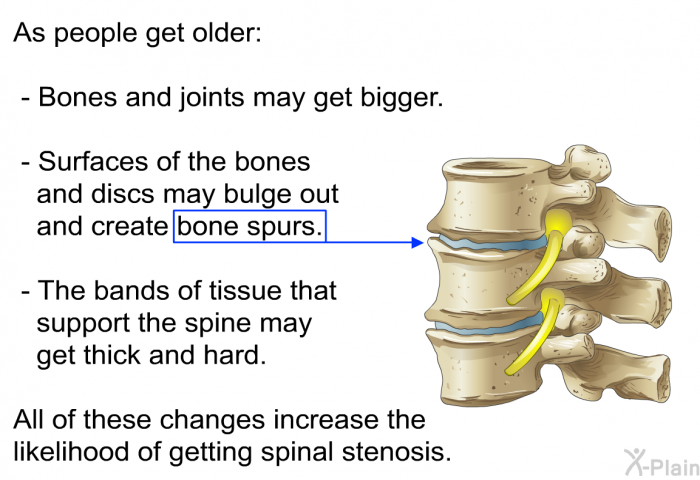 As people get older:  Bones and joints may get bigger. Surfaces of the bones and discs may bulge out and create bone spurs. The bands of tissue that support the spine may get thick and hard.  
All of these changes increase the likelihood of getting spinal stenosis.