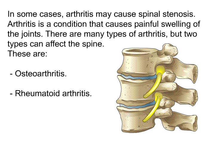 In some cases, arthritis may cause spinal stenosis. Arthritis is a condition that causes painful swelling of the joints. There are many types of arthritis, but two types can affect the spine. These are:  Osteoarthritis. Rheumatoid arthritis.