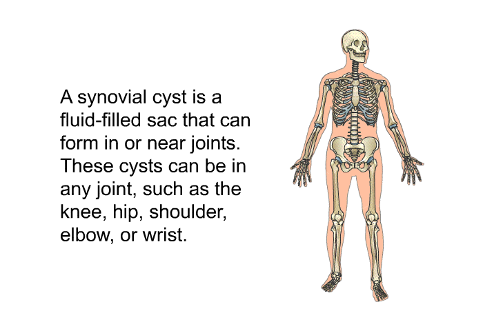 A synovial cyst is a fluid-filled sac that can form in or near joints. These cysts can be in any joint, such as the knee, hip, shoulder, elbow, or wrist.