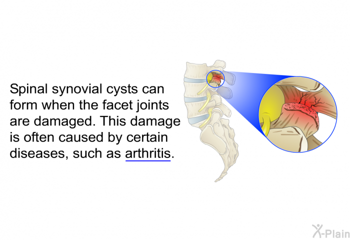 Spinal synovial cysts can form when the facet joints are damaged. This damage is often caused by certain diseases, such as arthritis.