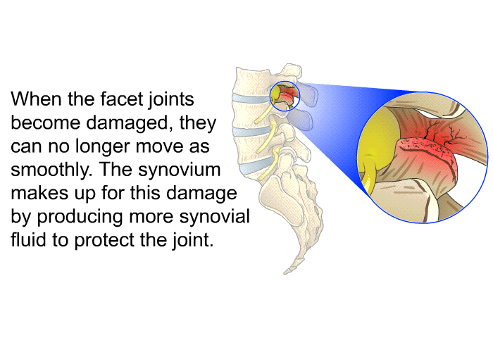 When the facet joints become damaged, they can no longer move as smoothly. The synovium makes up for this damage by producing more synovial fluid to protect the joint.