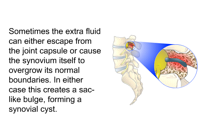 Sometimes the extra fluid can either escape from the joint capsule or cause the synovium itself to overgrow its normal boundaries. In either case this creates a sac-like bulge, forming a synovial cyst.