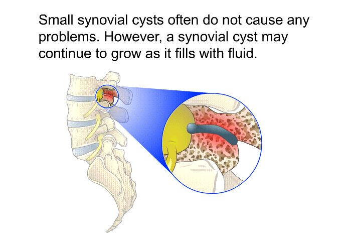 Small synovial cysts often do not cause any problems. However, a synovial cyst may continue to grow as it fills with fluid.