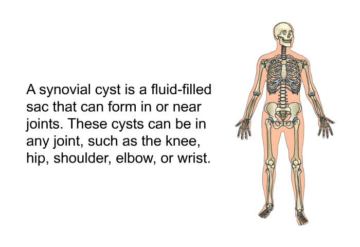 A synovial cyst is a fluid-filled sac that can form in or near joints. These cysts can be in any joint, such as the knee, hip, shoulder, elbow, or wrist.