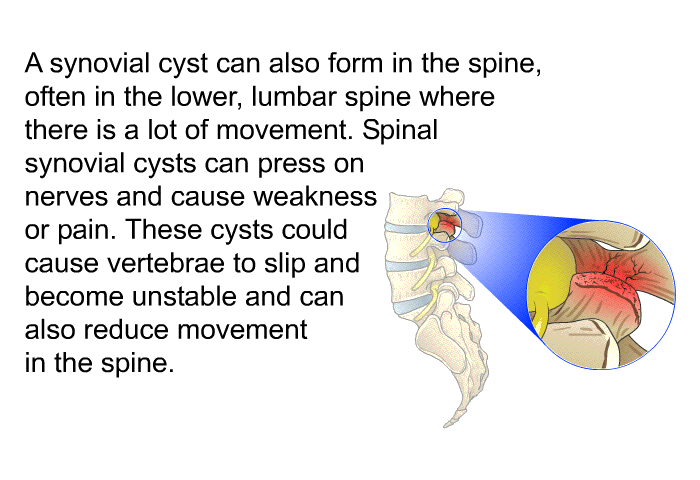 A synovial cyst can also form in the spine, often in the lower, lumbar spine where there is a lot of movement. Spinal synovial cysts can press on nerves and cause weakness or pain. These cysts could cause vertebrae to slip and become unstable and can also reduce movement in the spine.