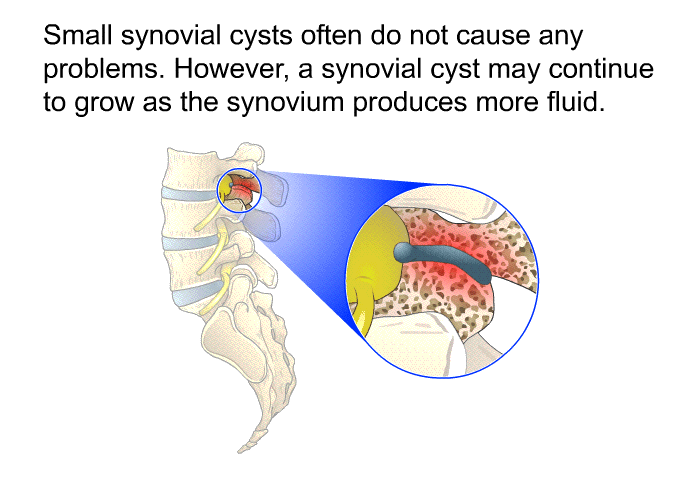 Small synovial cysts often do not cause any problems. However, a synovial cyst may continue to grow as the synovium produces more fluid.