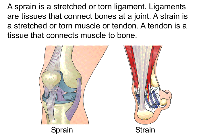 A sprain is a stretched or torn ligament. Ligaments are tissues that connect bones at a joint. A strain is a stretched or torn muscle or tendon. A tendon is a tissue that connects muscle to bone.