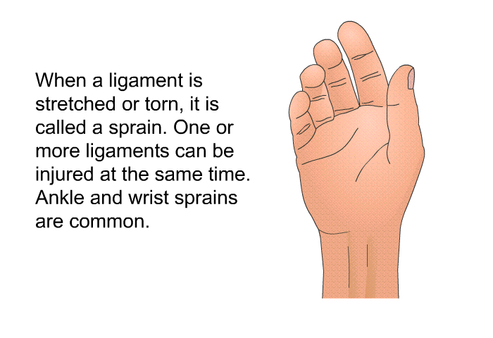 When a ligament is stretched or torn, it is called a sprain. One or more ligaments can be injured at the same time. Ankle and wrist sprains are common.