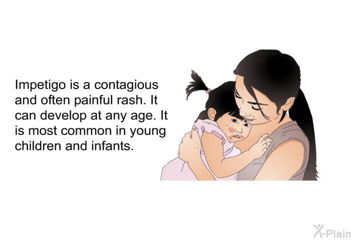 Impetigo is a contagious and often painful rash. It can develop at any age. It is most common in young children and infants.