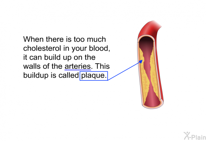 When there is too much cholesterol in your blood, it can build up on the walls of the arteries. This buildup is called plaque.