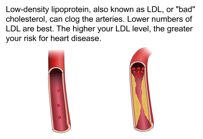 Low-density lipoprotein, also known as LDL, or "bad" cholesterol, can clog the arteries. Lower numbers of LDL are best. The higher your LDL level, the greater your risk for heart disease.