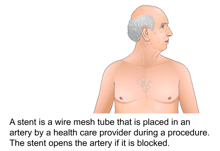 A stent is a wire mesh tube that is placed in an artery by a health care provider during a procedure. The stent opens the artery if it is blocked.