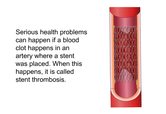 Serious health problems can happen if a blood clot happens in an artery where a stent was placed. When this happens, it is called stent thrombosis.